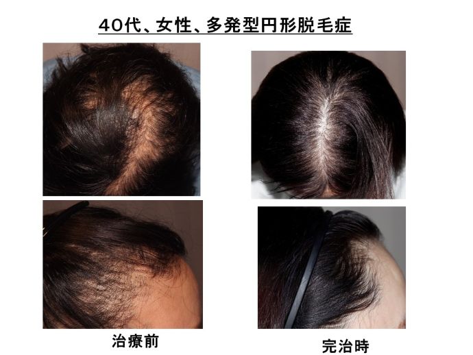 円形脱毛症　病院